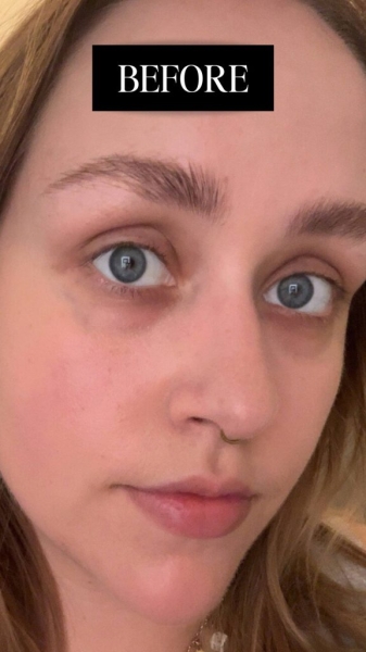 I’ve Tried Every Product for My Dark Under Eyes—This One Finally Worked